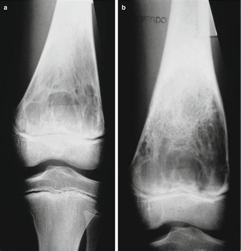 Aneurysmal Bone Cyst | Musculoskeletal Key