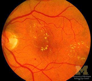 Retinal Hard Exudates : Ophthalmoscopic Abnormalities : The Eyes Have It