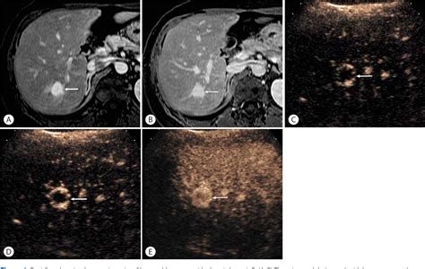 Figure From Contrast Enhanced Ultrasound Ceus Liver Imaging