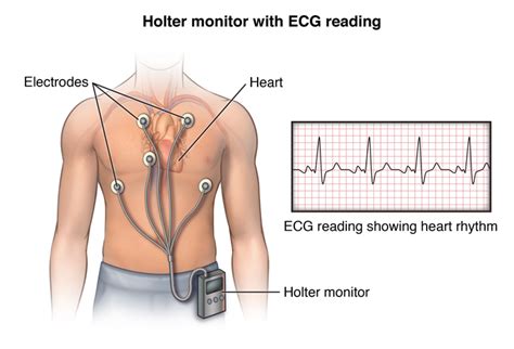 Holter 24 Horas O que é Como se realiza Para que serve ICOR