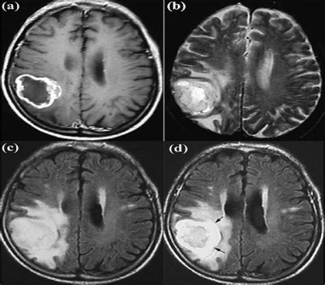 A T Weighted Mri B T Weighted Mri C Flair And D Flair With