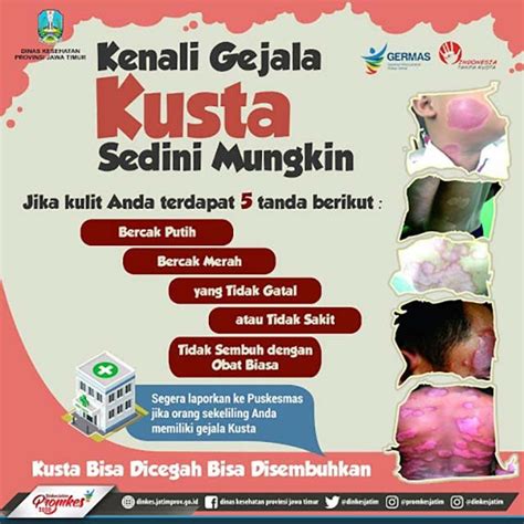 Disabilitas Kusta Cara Mengatasinya Dan Cara Mendukung Penyandang Kusta