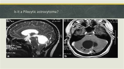 Isolated Intracranial Hydatid Cyst Multidisplinary Approach