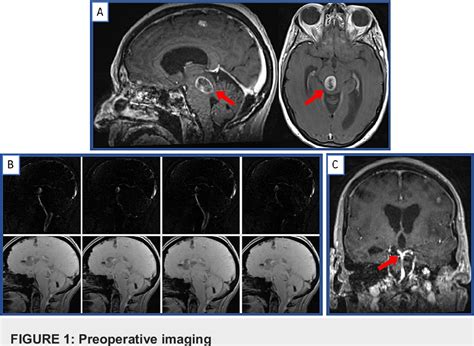 [pdf] Endoscopic Third Ventriculostomy Using Penumbra Artemis™ Neuro Evacuation Device