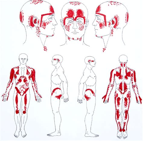 Myofasciale Pijnlocaties Acupunctuur Nijmegen