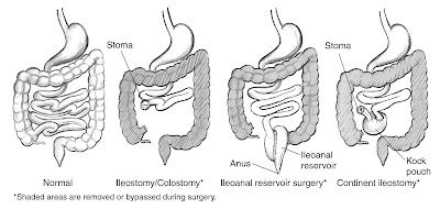 Seeking Healthy Life: What is an Ileostomy Surgery? – Types of an Ileostomy