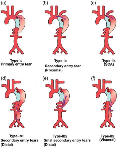 Figure 1 From Proposed Classification Of Endoleaks After Endovascular