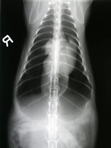 Pleural Disease Flashcards Quizlet