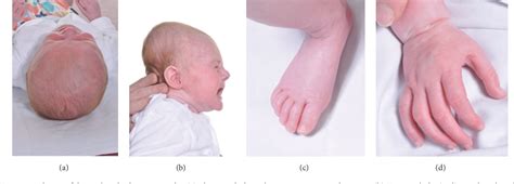 Figure 2 From A Case Of Neonatal Marfan Syndrome A Management Conundrum And The Role Of A