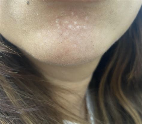 I 35f Have Developed These Small Bumps On My Chin More In Comments R 30plusskincare