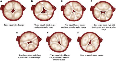 Hurwitz And Roberts Classification Of The Quadricuspid Aortic Valve