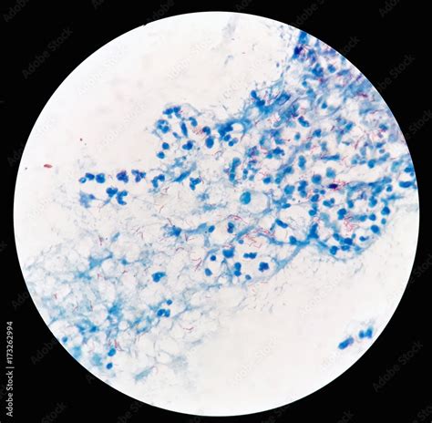 Smear Of Acid Fast Bacilli Afb Stained From Human Body Fluid Specimen