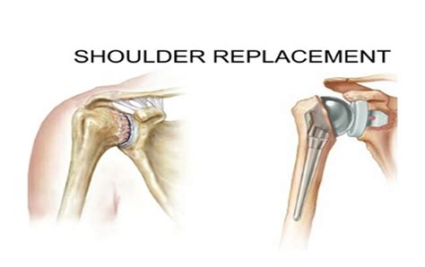 Dr Rajesh Garg How Do Shoulder Replacement Surgery Help Patients To