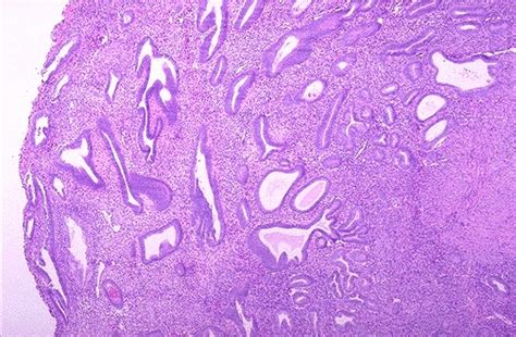 Female Genital Pathology