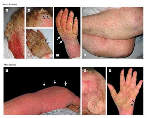 Figure 1 From Crusted Norwegian Scabies In An Adult With Langerhans