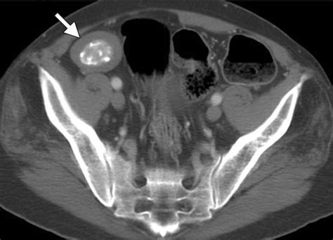 Imaging Manifestations Of Abdominal Fat Necrosis And Its Mimics