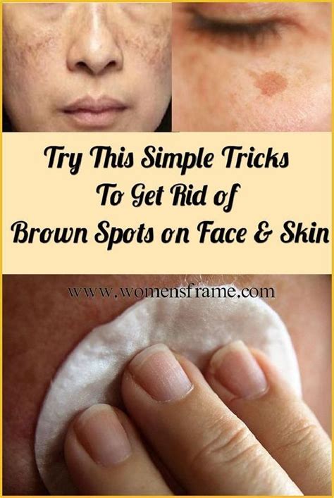 Get Rid Of The Brown Marks On Your Skin With This Simple Trick Brown