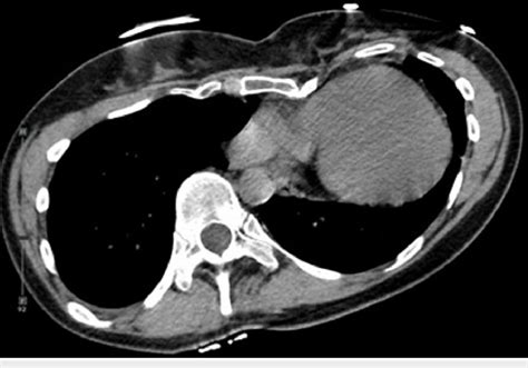 Preoperative Chest Computed Tomography Showing Significant Pectus