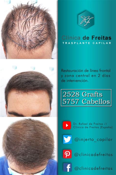 cuidadosamente taburete muñeca trasplante de cabello resultados