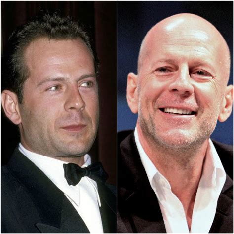 Bruce Willis Hair Loss