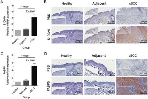 S100a9 And Fabp5 Were Highly Expressed In Cscc Tissue A B S100a9 Was