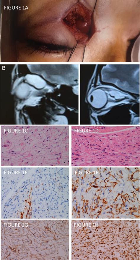 Novel Case Of Hybrid Perineurioma Neurofibroma Of The Orbit Canadian