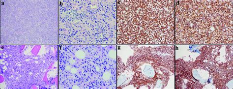 Cervical Lymph Node Biopsy And Bone Marrow Biopsy Histology And