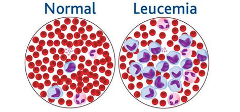 5 Principales signos y síntomas de la leucemia