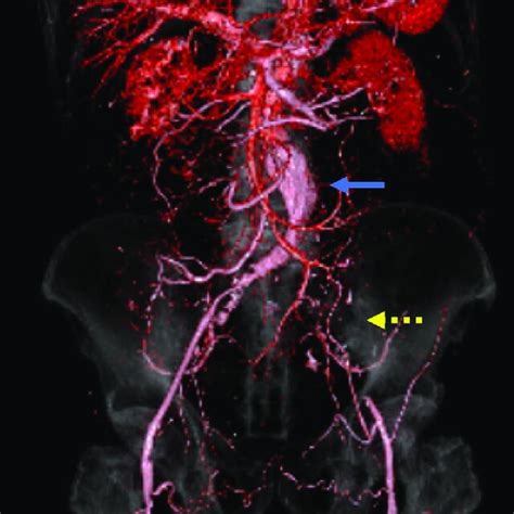 Preoperative Computed Tomography Angiography Images An Abdominal Download Scientific Diagram