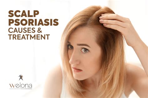 Scalp Psoriasis Causes And Treatment