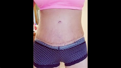 Mommy Makeover Weeks Post Op Tummy Shot And Update Youtube