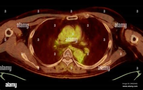 A Pet Ct Scan Image Is A Diagnostic Visualization Combining Positron