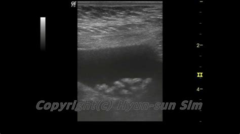 Gallbladder Ultrasound Cholecystolithiasis 담낭결석 6 Youtube