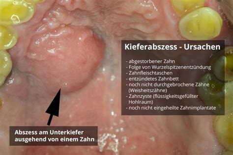 Kieferabszess Ursachen Symptome Behandlung