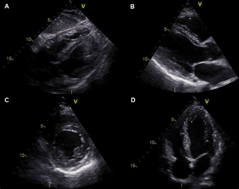 Follow Up Echocardiography Showing Almost Complete Resolution Of