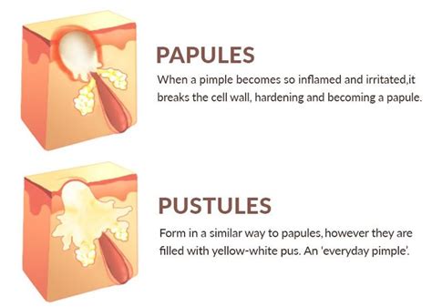 How To Get Rid Of Papules | Papules acne, Types of acne, Acne treatment