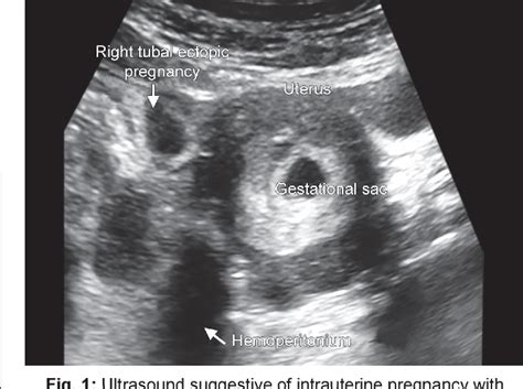 Figure 1 From Heterotopic Pregnancy Successful Management By