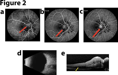 Choroidal Neovascular Membrane Diagram