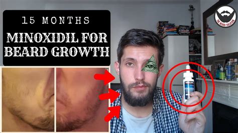 Minoxidil Beard Growth Results 15 Months On Minoxidil For Beard