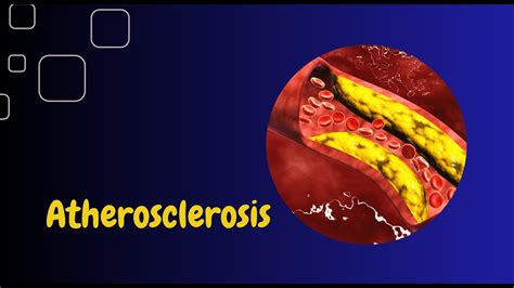 Cvs Pathology Atherosclerosis Youtube