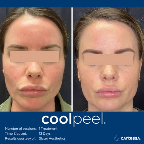 Cool Peel CO2 Laser Atlantic Aesthetics Maine