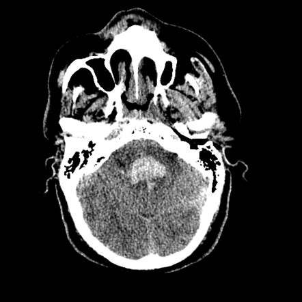 Duret hemorrhage | Radiology Reference Article | Radiopaedia.org