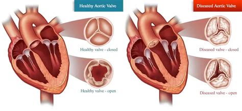 The Sex Of Your Cells Matters When It Comes To Heart Disease