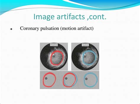 Ppt Angiography Powerpoint Presentation Free Download Id 5177574