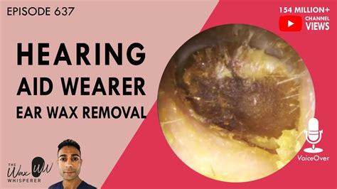 637 Hearing Aid Wearer Ear Wax Removal YouTube