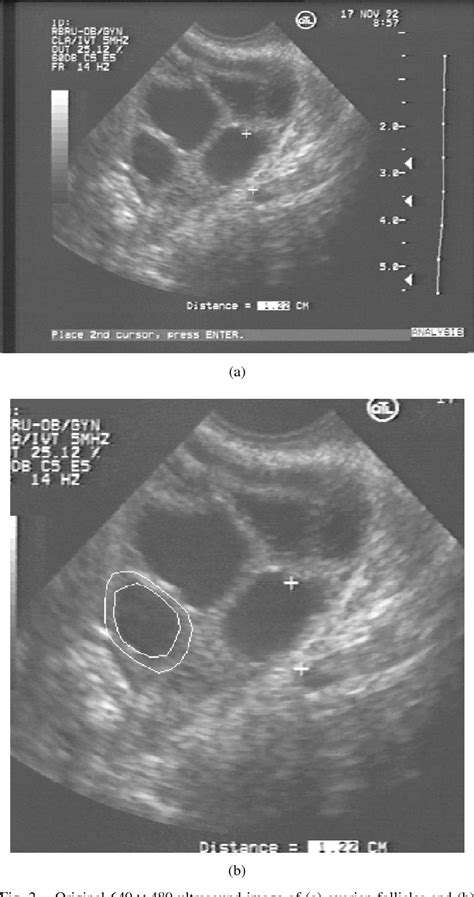 Ovarian Follicle Ultrasound