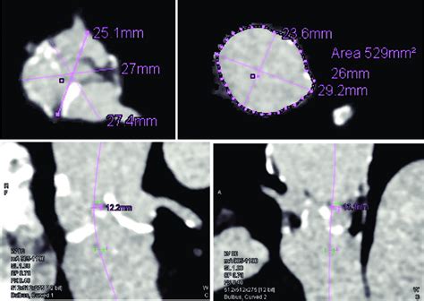 CT aortogram measurements: aortic annulus (up left); sinus of Valsalva ...