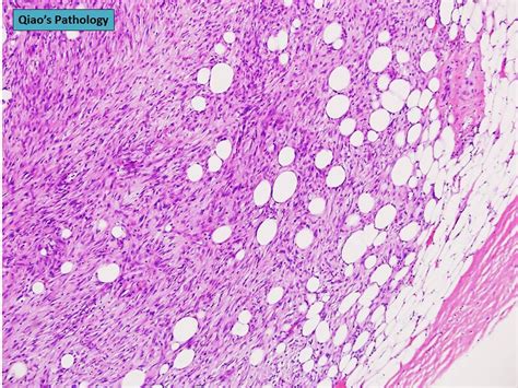 Qiao S Pathology Malignant Phyllodes Tumor Of The Breast A Photo On