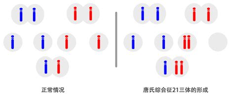 唐氏综合征21 三体综合征新华医学遗传网