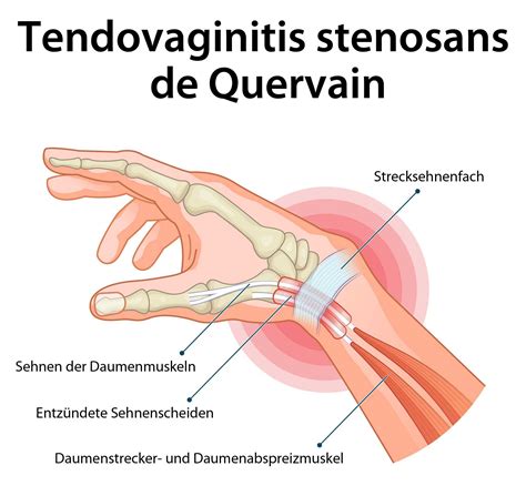 Tendovaginitis Stenosans De Quervain Ursachen Behandlung